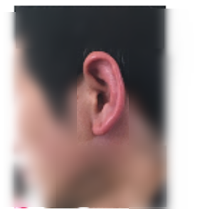 外耳炎1